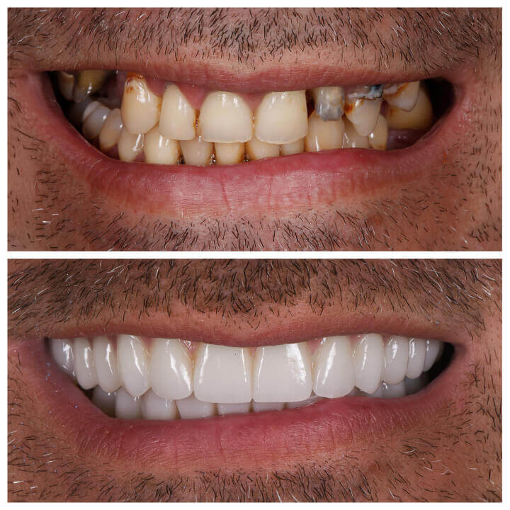 resin veneers brisbane