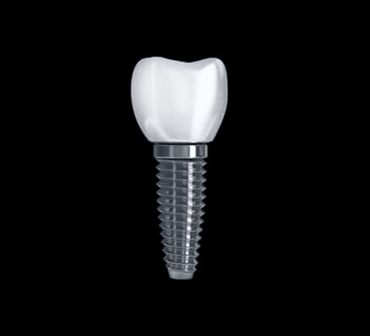 Single tooth implants Perth Western Australia