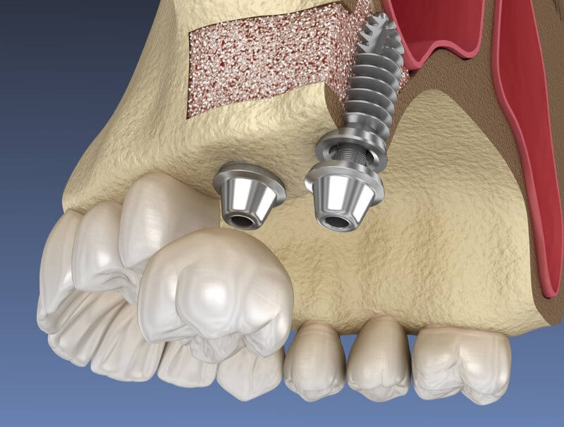 sinus lift surgery