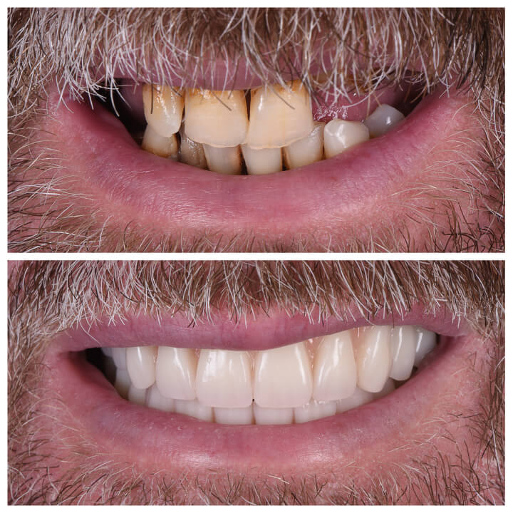 teeth veneers