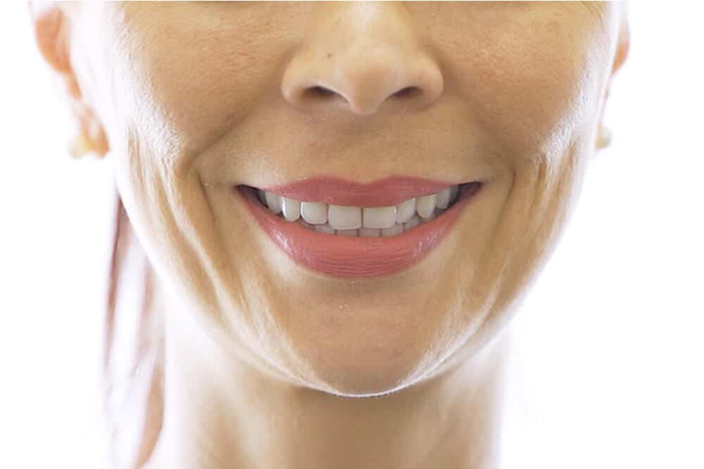 woman's smile after dental implant treatment